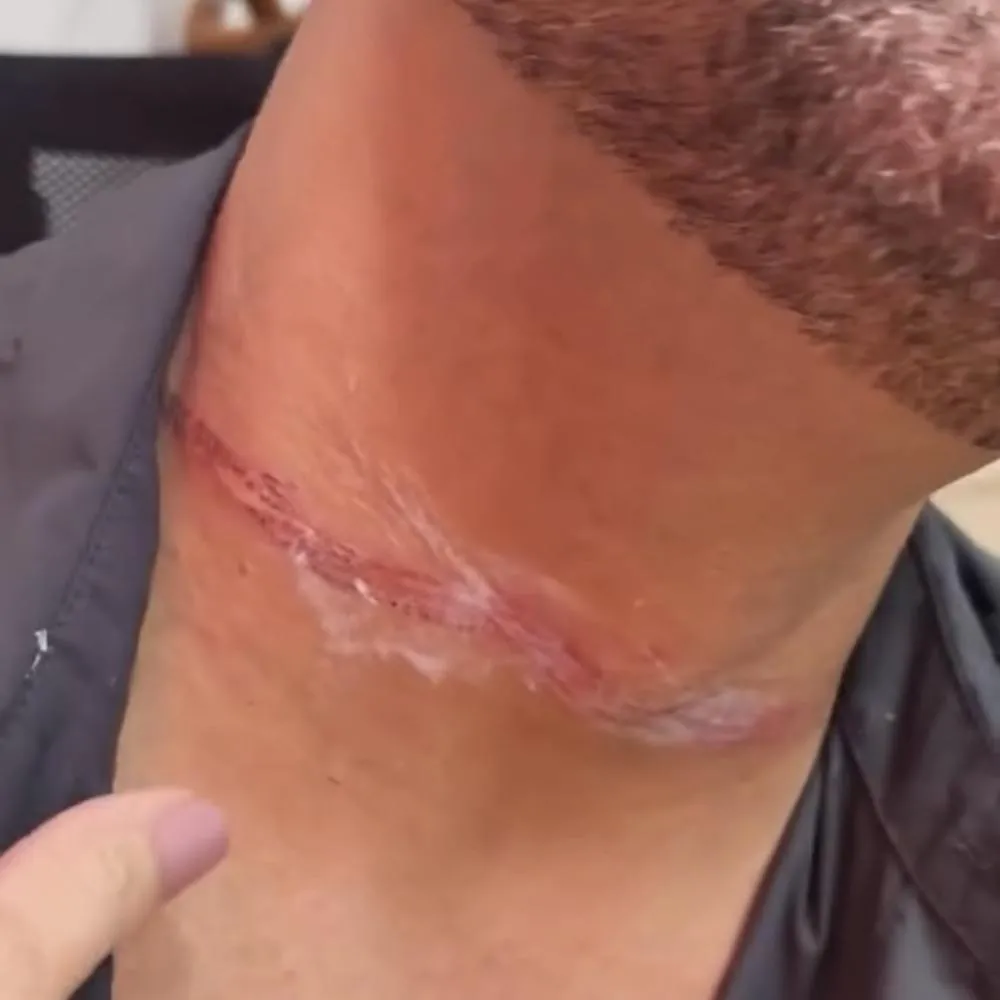 Fio solto provoca acidente com secretário de Cuiabá